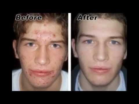 Facial peels acne