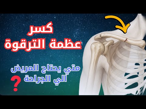 كسر عظم الترقوة كسر عظمة الترقوة أسبابه وأعراضه وطريقة العلاج الصحيحة مضاعفات كسر عظم الترقوة