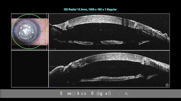 More insights during DMEK surgery with Enfocus intrasurgical OCT