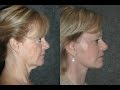 Mini Facelift by Face Lifting Expert Dr Jacono #minifacelift