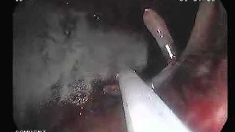 Полисахаридная система EndoClot PHS