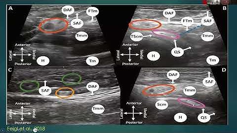 Neuropathic Shoulder by Jeimylo C. de Castro, MD