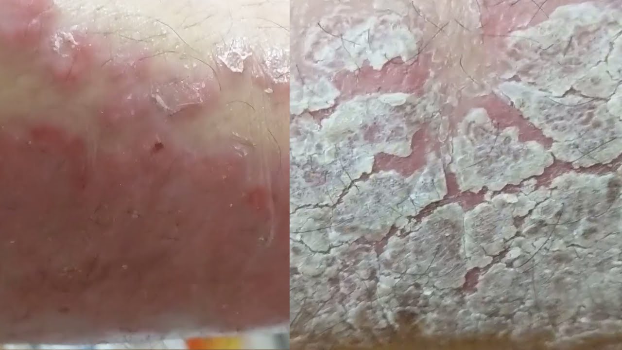 psoriasis flakes removal