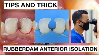 Tips and Trick Rubberdam Anterior Isolation | General Dentist Griya RR