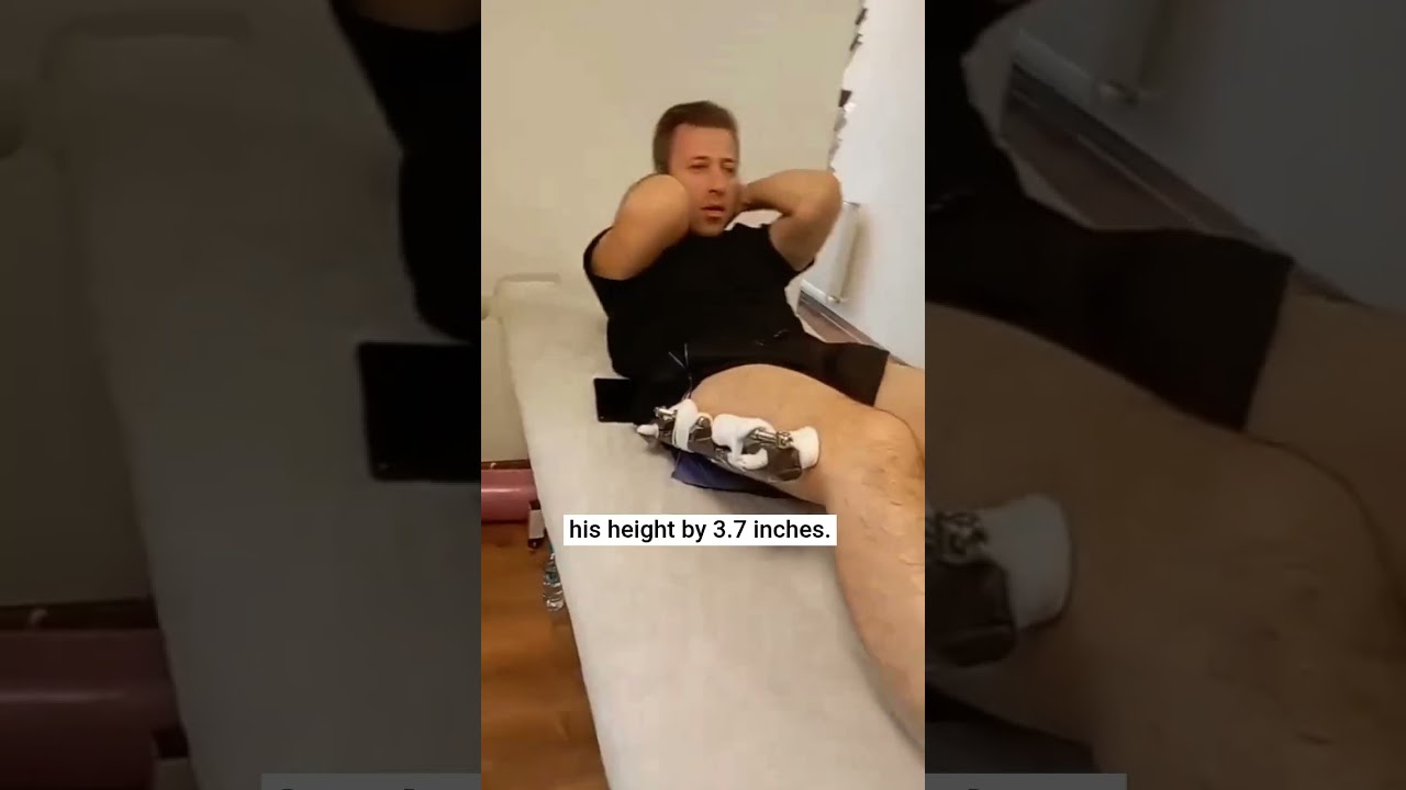 Student pays £36k to have his legs broken in surgery to become 3 7in taller