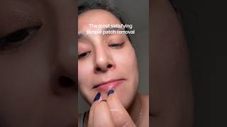 #pimplepatch #pimplepatches #pimplesremoval #skincarejourney