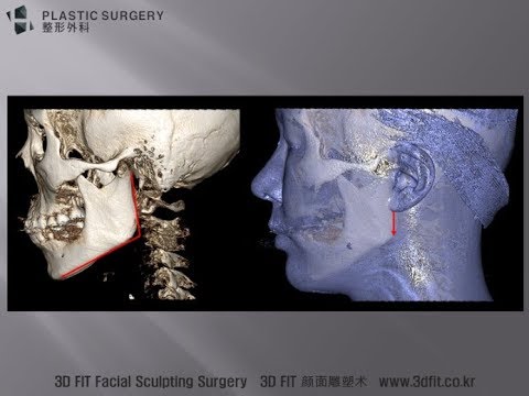 [H整形医院]  给准备下颌角手术的患者1