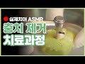 ▶ 충치 치료과정 낱낱히 보여드립니다◀인레이/골드크라운 치료과정 :: 치과 ASMR ::