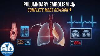 Pulmonary Embolism Explained | Diagnosis, Wells Score, Management & Clinical Case | MBBS Revision