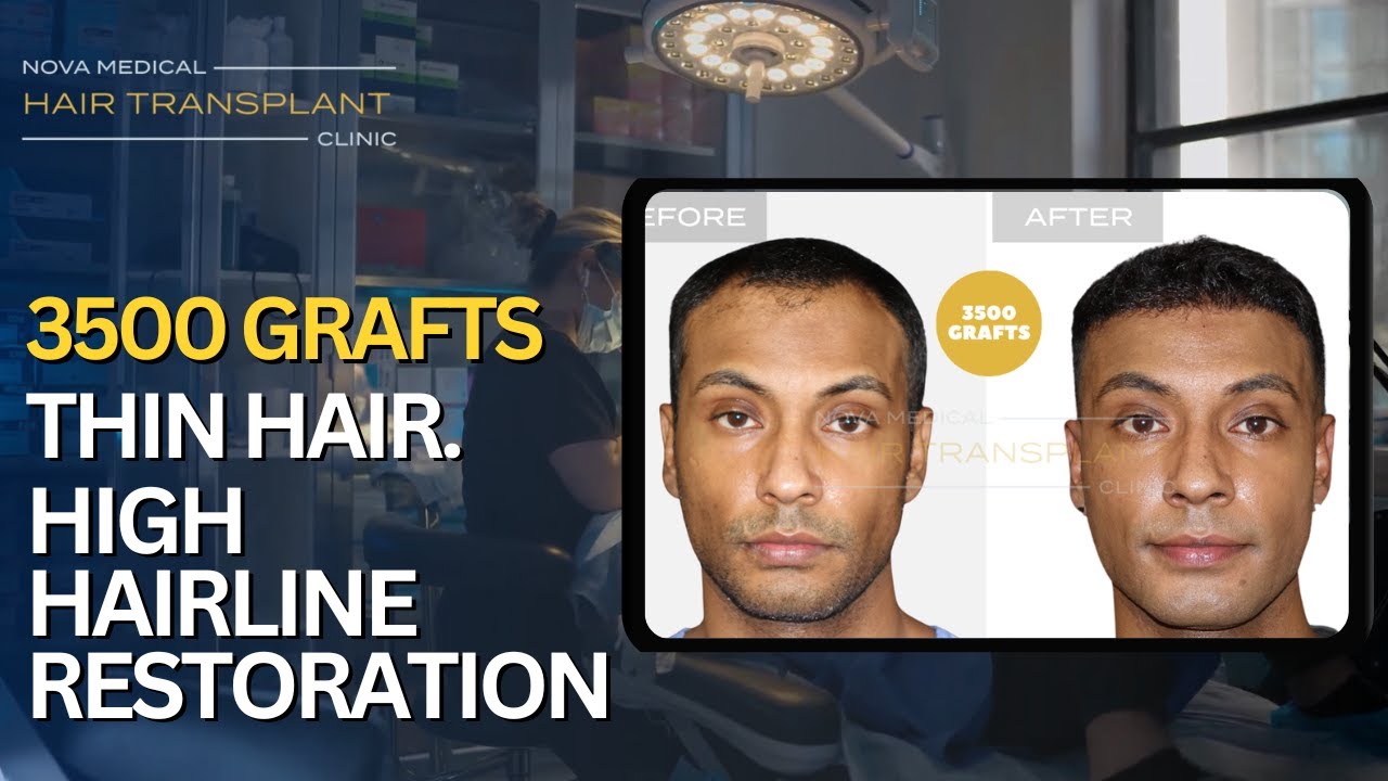 3,500 Grafts Later… Watch This Transformation! | Nova Medical Hair Transplant Miami