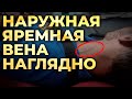 Наружная яремная вена - как улучшить визуализацию. #ПроСМП