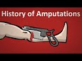 The History of Amputation Explained