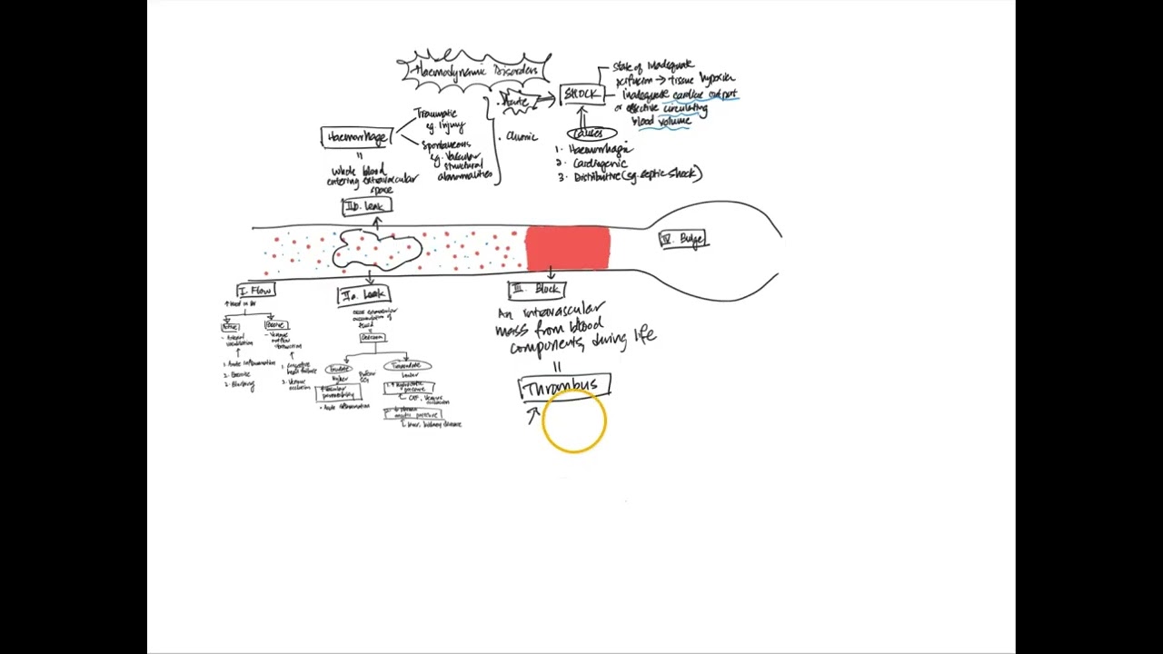 Haemodynamic Disorders Overview: Part 2/2 Thrombosis, Embolism, Aneurysm