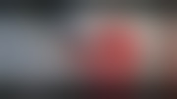 Total gastrectomy + Distal pancreatico-splenectomy &  segmental Transverse colectomy