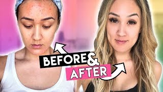 How I Cleared My Acne/Skin: Full Skincare Routine