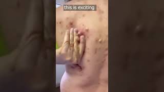 pimple popping 2022 new, blackheads on nose, pimple popping tiktok 4523rww