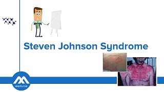 Stevens-Johnson Syndrome: Causes, Diagnosis, Differentials, Symptoms and Treatment