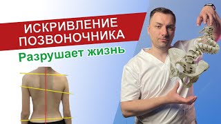 Что такое сколиоз? / Как исправить сколиоз / Искривление позвоночника.