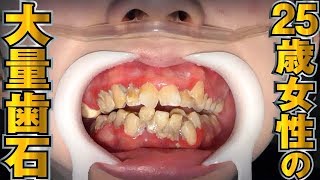 25歳女性の大量歯石[Remove tartar]歯石除去Vol.10(牙石去除)