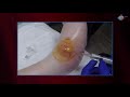 WCW: Draining an Abscess on Top of the Foot