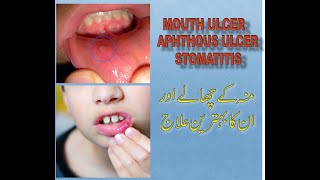 Mouth ulcer|Aphthous ulcer(Canker sore)|Aphthous Stomatitis Treatment urdu/hindi by Dr. Safdar Iqbal