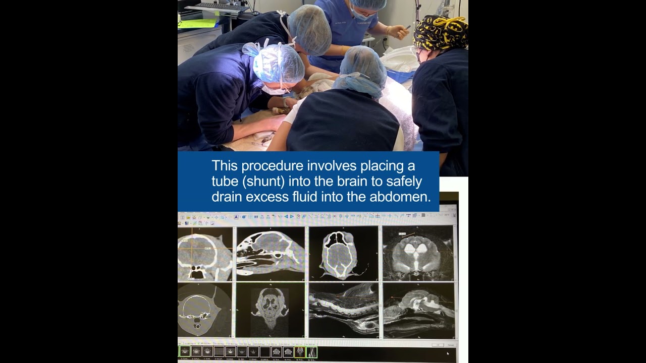 Success Story: Ventriculoperitoneal (VP) Shunt Placement