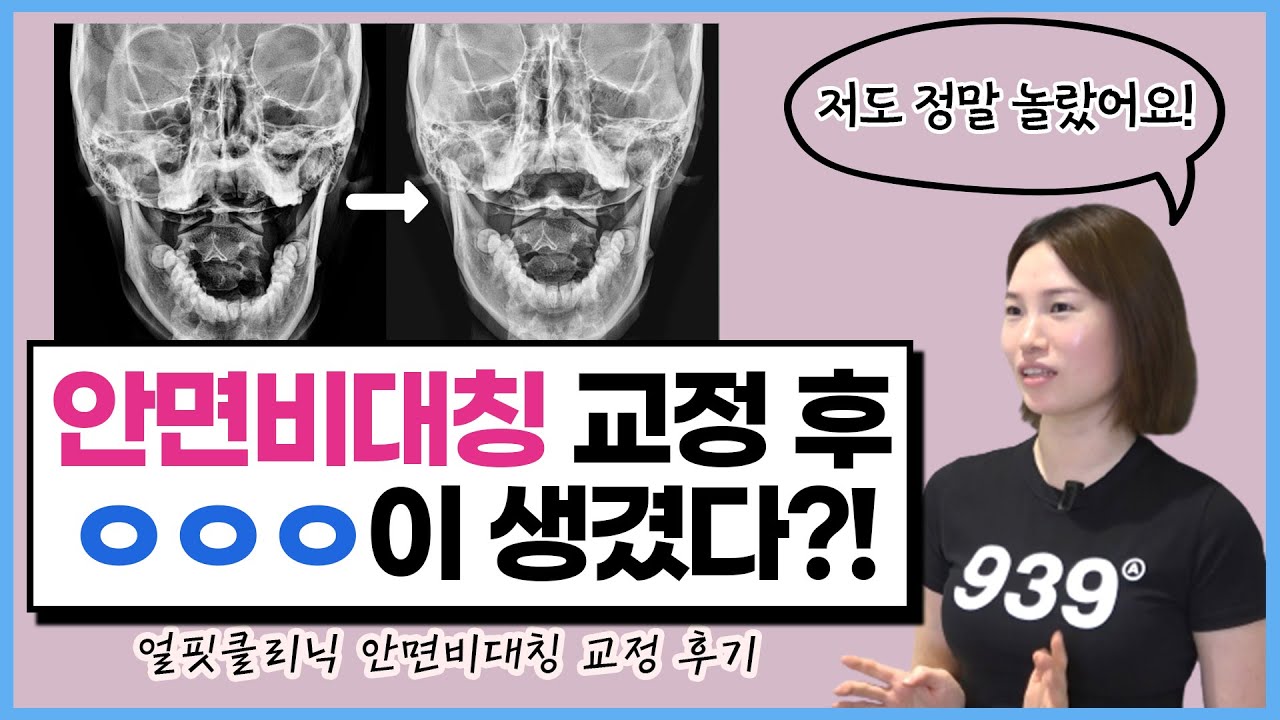 안면비대칭 교정 10회차 후기) 3