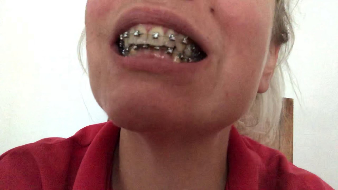 Michelle’s Invisalign to Braces. Day 48 quick update before adjustment Day and side view of