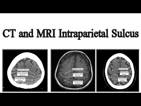 वीडियो: मनुष्यों में इंट्रापैरिएटल सल्कस?