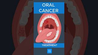 Oral cancer: Treatment | Kenhub #oralcancer