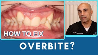 How to Fix Overbite with Braces or Invisalign®?