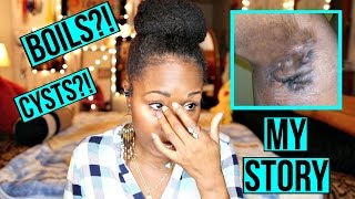 Boils Under My Armpits & Inner Thighs?! | My Hidradenitis Suppurativa HORROR STORY