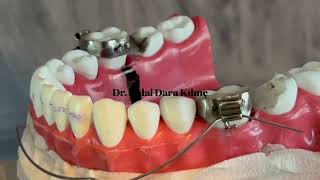 Ortodonti İntrüzyon Arkı Keser Diş İntrüzyon Orthodontic Intrusion Arch Effects On Molar Teeth