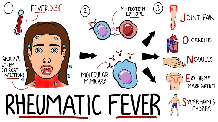 Rheumatic Fever Made Easy (Including Jones Criteria and Mnemonic!) - DayDayNews
