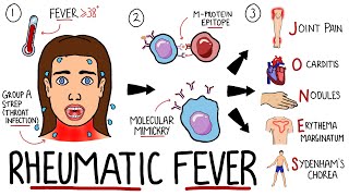 Rheumatic Fever Made Easy (Including Jones Criteria and Mnemonic!) screenshot 5