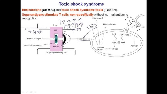 Toxic shock syndrome, Sings Causes Cure