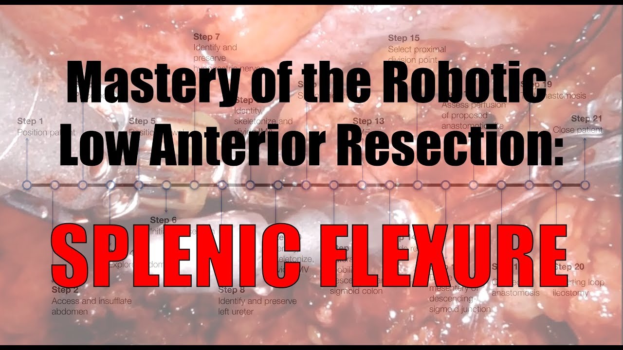 Robotic Low Anterior Resection Splenic Flexure Mobilization/Takedown