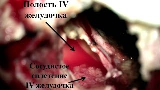 Хирургическое лечение продолженного роста вестибулярной шванномы часть 3