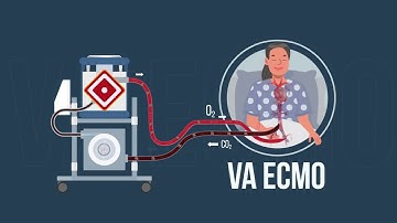 What is ECMO (Extracorporeal Membrane Oxygenation)?