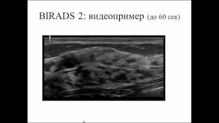 BIRADS: категоризация очаговых изменений молочных желез