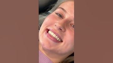 How Braces Are Removed 🦷 #BracesOff