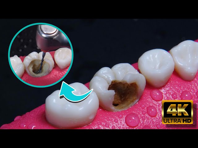 AMAZING reconstruction of tooth damaged by caries: Endodontics class=