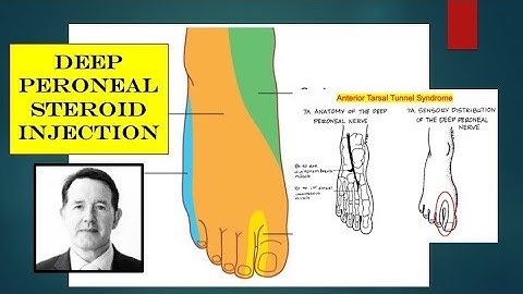 Video - Iatrogenic DP Nerve Entrapment and CSI Review