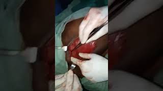 Modified radical mastectomy - Axillary dissection