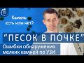 Мелкий камень почки (песок в почке). Почему нельзя доверять УЗИ