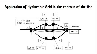 Application of Hyaluronic Acid in the contour of the lips screenshot 4