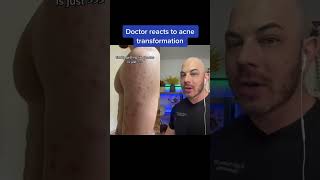 Doctor reacts to insane acne transformation! #dermreacts #doctorreacts #acnetransformation