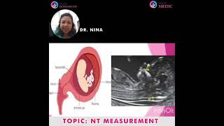 Ultrasound | NT Measurement | Dr Nina Navakumar | StudyULTRASOUND