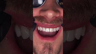 Trying In 10 Lux No Prep Veneers No Shaving, No Drilling, No Pain