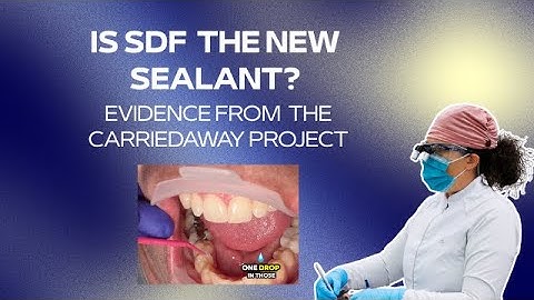SDF Is The New Sealant: Evidence from a Study